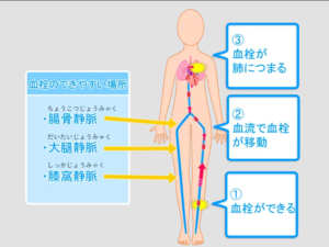 医師は肺塞栓症が喀血の原因であるかどうかをどのようにして判断するのでしょうか?
